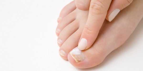 Treating Nail Fungus: 5 Effective Home Remedies