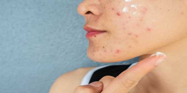 Effective Skincare Routine For Clear Skin: Say Goodbye To Acne